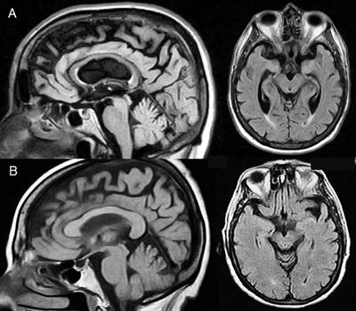 Case Report: Barely Able to Speak, Can’t Stop Echoing: Echolalic Dynamic Aphasia in Progressive Supranuclear Palsy